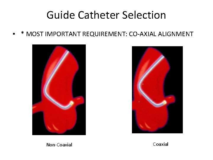 Guide Catheter Selection • * MOST IMPORTANT REQUIREMENT: CO-AXIAL ALIGNMENT Non-Coaxial 