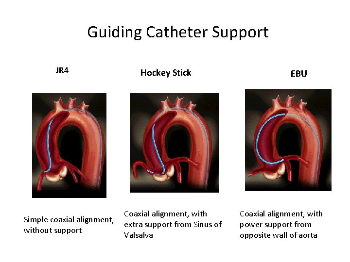 Guiding Catheter Support JR 4 Simple coaxial alignment, without support Hockey Stick Coaxial alignment,