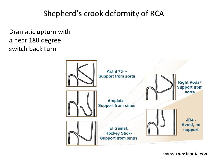 Shepherd’s crook deformity of RCA Dramatic upturn with a near 180 degree switch back