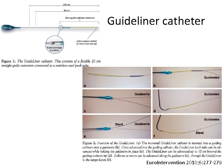 Guideliner catheter Euro. Intervention 2010; 6: 277 -279 