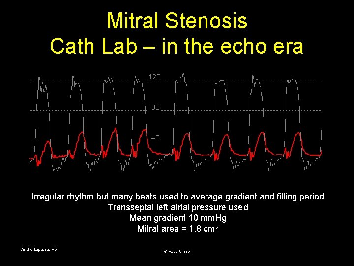 Mitral Stenosis Cath Lab – in the echo era Irregular rhythm but many beats