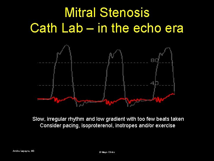 Mitral Stenosis Cath Lab – in the echo era Slow, irregular rhythm and low