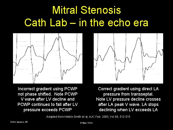 Mitral Stenosis Cath Lab – in the echo era Incorrect gradient using PCWP not