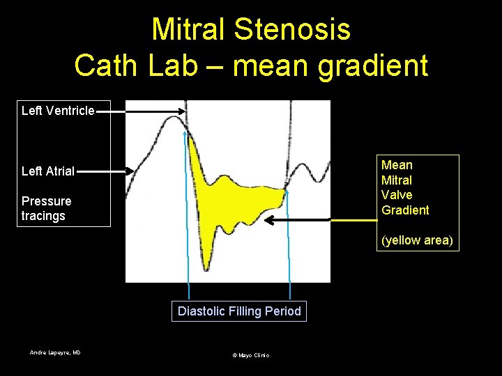 Mitral Stenosis Cath Lab – mean gradient Left Ventricle Mean Mitral Valve Gradient Left