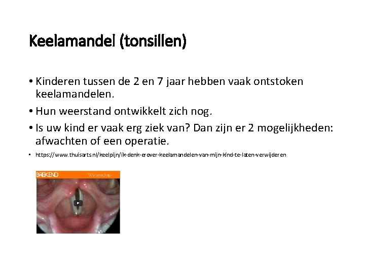 Keelamandel (tonsillen) • Kinderen tussen de 2 en 7 jaar hebben vaak ontstoken keelamandelen.