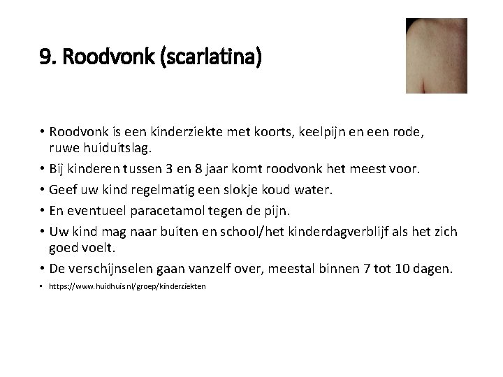 9. Roodvonk (scarlatina) • Roodvonk is een kinderziekte met koorts, keelpijn en een rode,