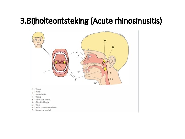 3. Bijholteontsteking (Acute rhinosinusitis) 