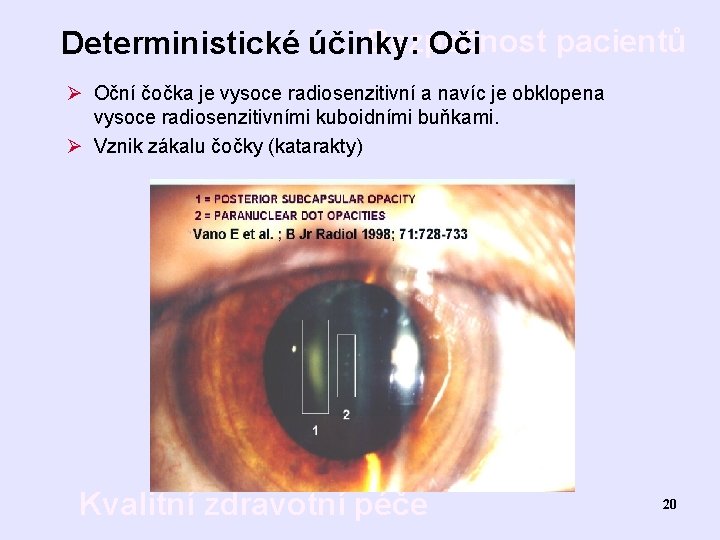 Bezpečnost pacientů Deterministické účinky: Oči Ø Oční čočka je vysoce radiosenzitivní a navíc je