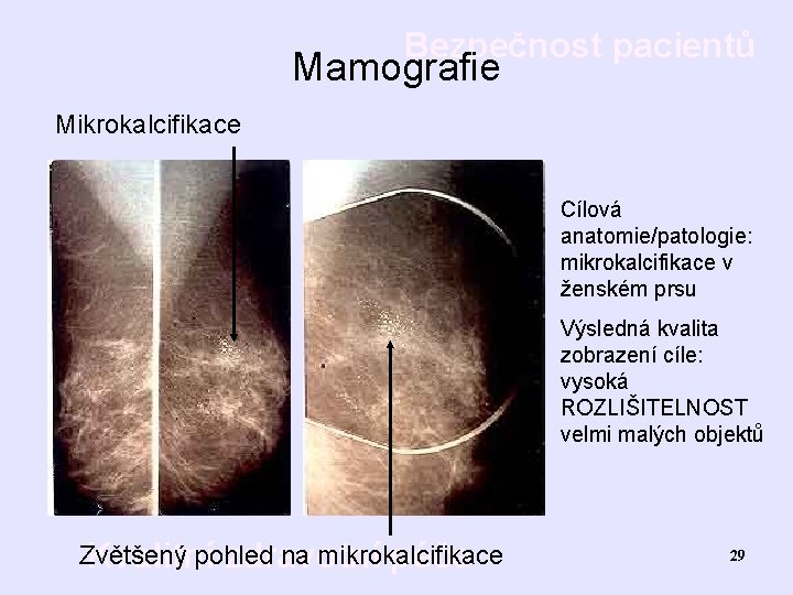 Bezpečnost pacientů Mamografie Mikrokalcifikace Cílová anatomie/patologie: mikrokalcifikace v ženském prsu Výsledná kvalita zobrazení cíle: