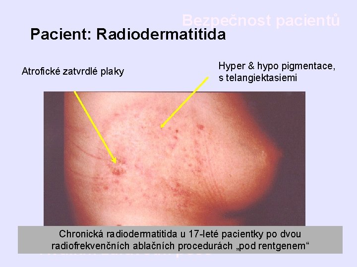 Bezpečnost pacientů Pacient: Radiodermatitida Atrofické zatvrdlé plaky Hyper & hypo pigmentace, s telangiektasiemi Chronická