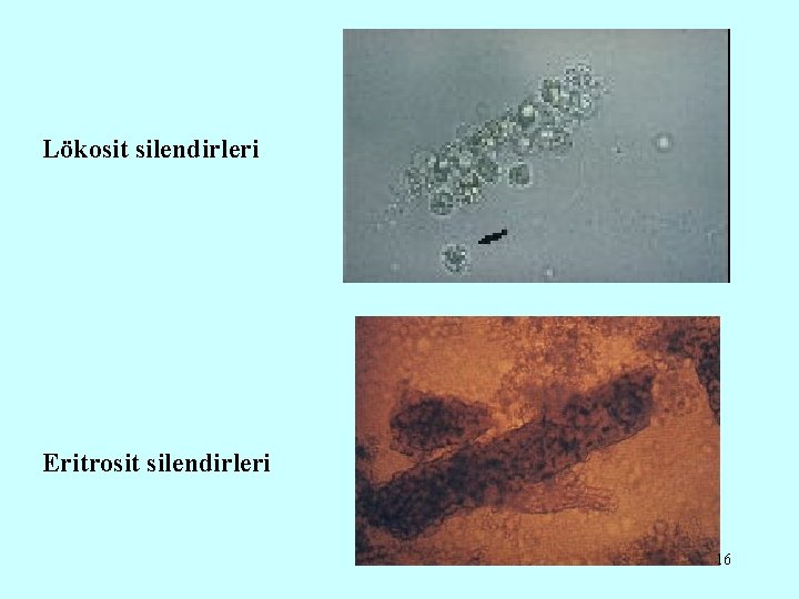 Lökosit silendirleri Eritrosit silendirleri 16 