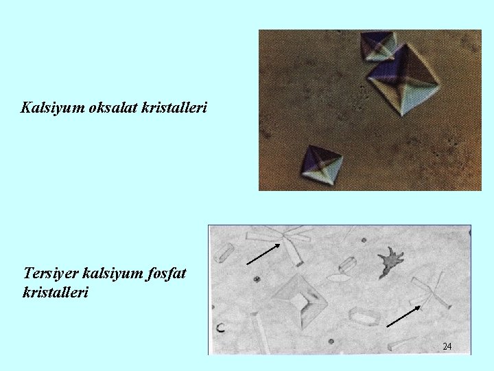 Kalsiyum oksalat kristalleri Tersiyer kalsiyum fosfat kristalleri 24 