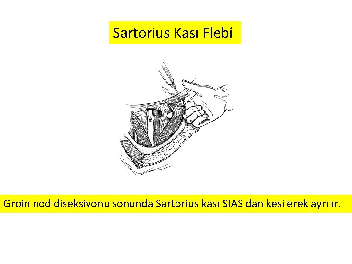 Sartorius Kası Flebi Groin nod diseksiyonu sonunda Sartorius kası SIAS dan kesilerek ayrılır. 