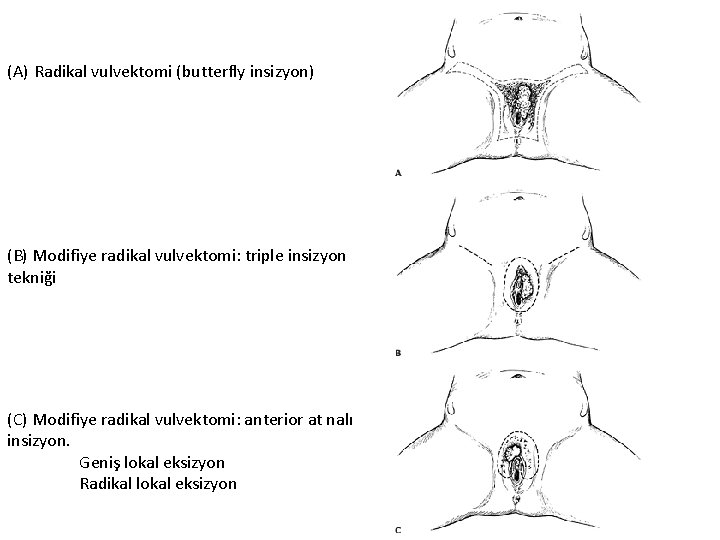 (A) Radikal vulvektomi (butterfly insizyon) (B) Modifiye radikal vulvektomi: triple insizyon tekniği (C) Modifiye