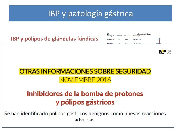 IBP y patología gástrica IBP y pólipos de glándulas fúndicas • Relación avalada por