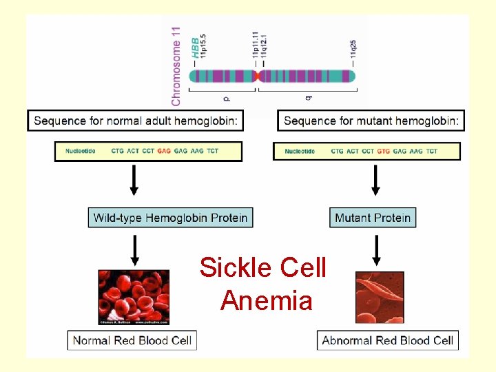 Sickle Cell Anemia 