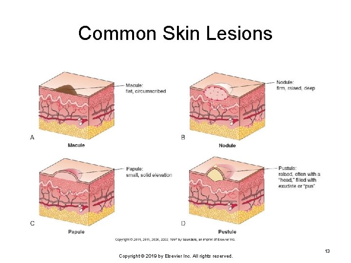 Common Skin Lesions Copyright © 2019 by Elsevier Inc. All rights reserved. 13 