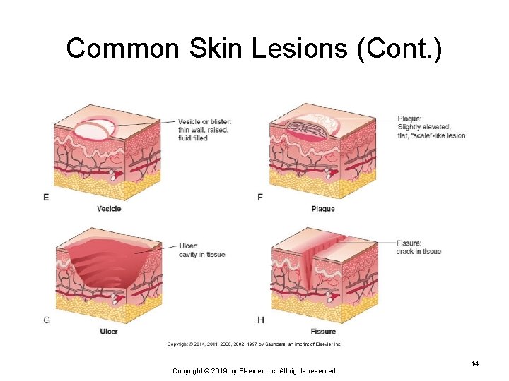Common Skin Lesions (Cont. ) Copyright © 2019 by Elsevier Inc. All rights reserved.