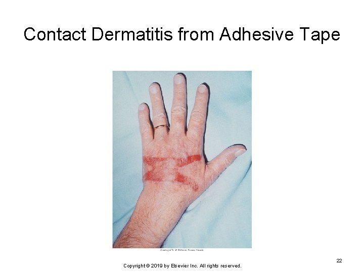 Contact Dermatitis from Adhesive Tape Copyright © 2019 by Elsevier Inc. All rights reserved.