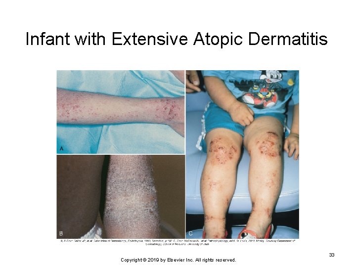 Infant with Extensive Atopic Dermatitis Copyright © 2019 by Elsevier Inc. All rights reserved.