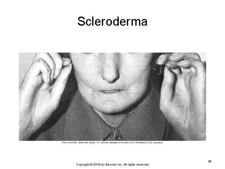 Scleroderma Copyright © 2019 by Elsevier Inc. All rights reserved. 48 