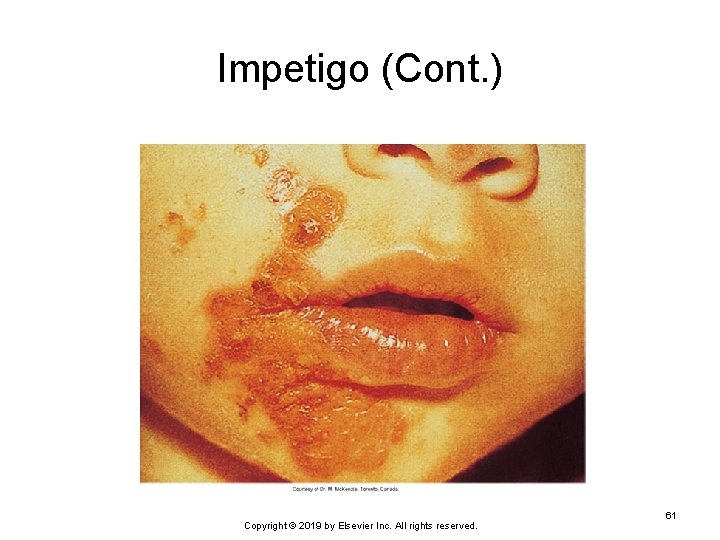 Impetigo (Cont. ) Copyright © 2019 by Elsevier Inc. All rights reserved. 61 