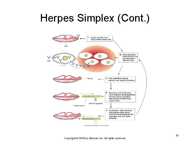 Herpes Simplex (Cont. ) Copyright © 2019 by Elsevier Inc. All rights reserved. 70