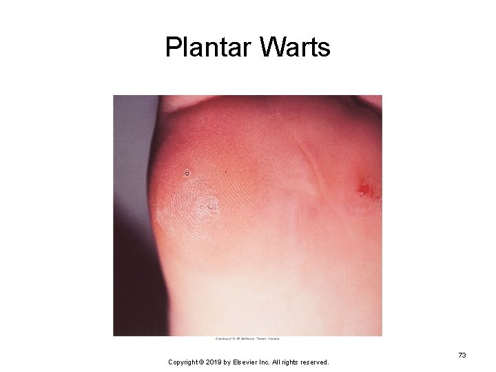 Plantar Warts Copyright © 2019 by Elsevier Inc. All rights reserved. 73 