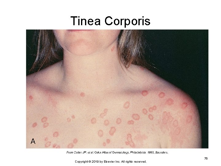Tinea Corporis Copyright © 2019 by Elsevier Inc. All rights reserved. 76 