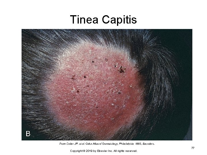 Tinea Capitis Copyright © 2019 by Elsevier Inc. All rights reserved. 77 