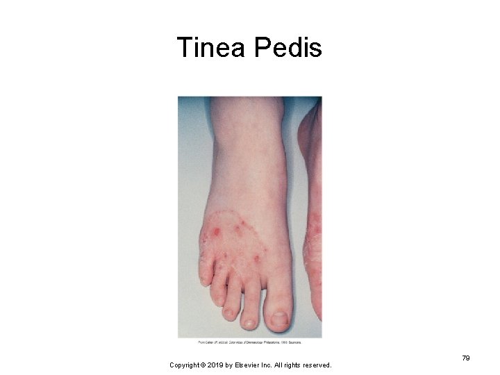 Tinea Pedis Copyright © 2019 by Elsevier Inc. All rights reserved. 79 