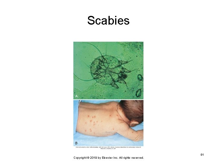 Scabies Copyright © 2019 by Elsevier Inc. All rights reserved. 81 