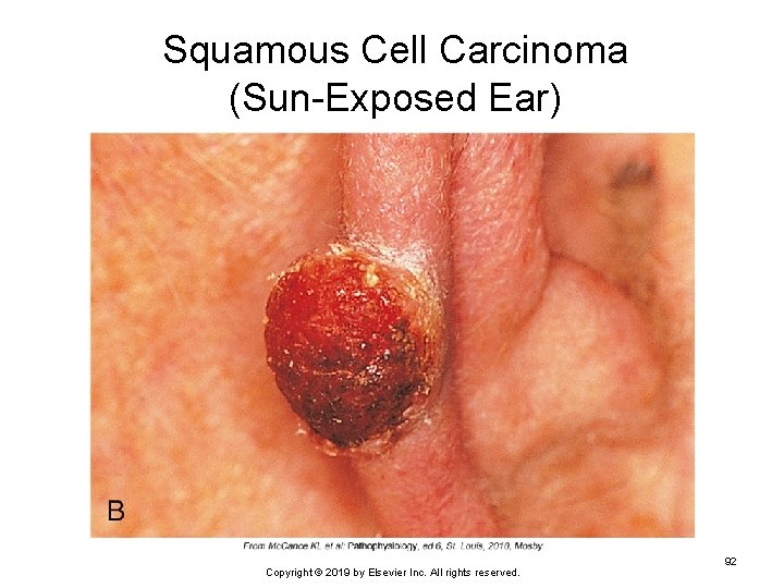 Squamous Cell Carcinoma (Sun-Exposed Ear) Copyright © 2019 by Elsevier Inc. All rights reserved.