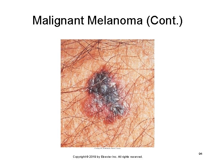 Malignant Melanoma (Cont. ) Copyright © 2019 by Elsevier Inc. All rights reserved. 94