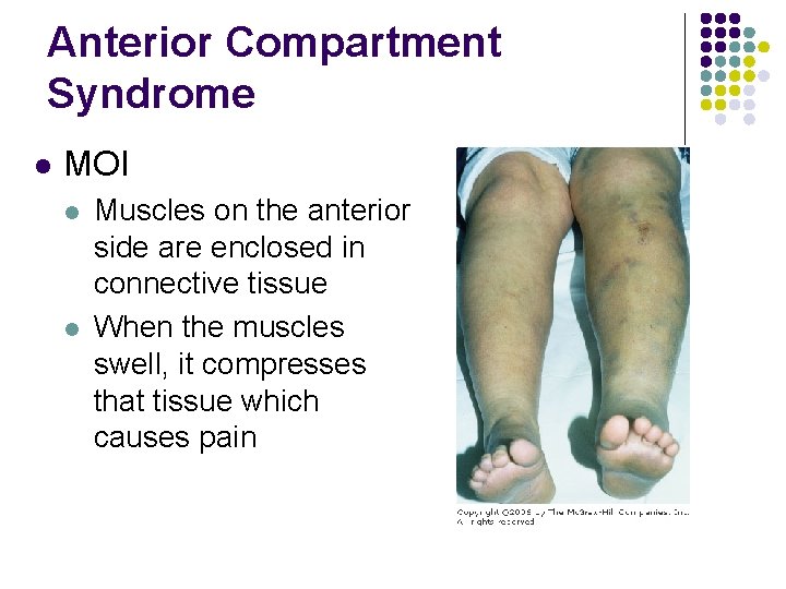 Anterior Compartment Syndrome l MOI l l Muscles on the anterior side are enclosed