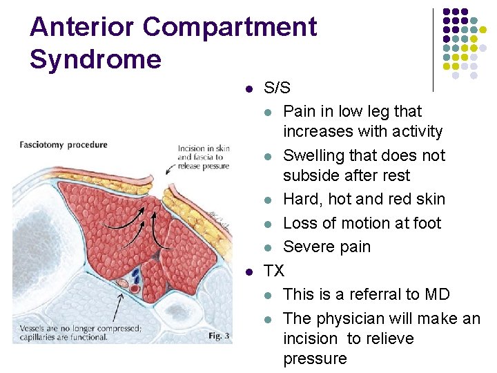 Anterior Compartment Syndrome l l S/S l Pain in low leg that increases with