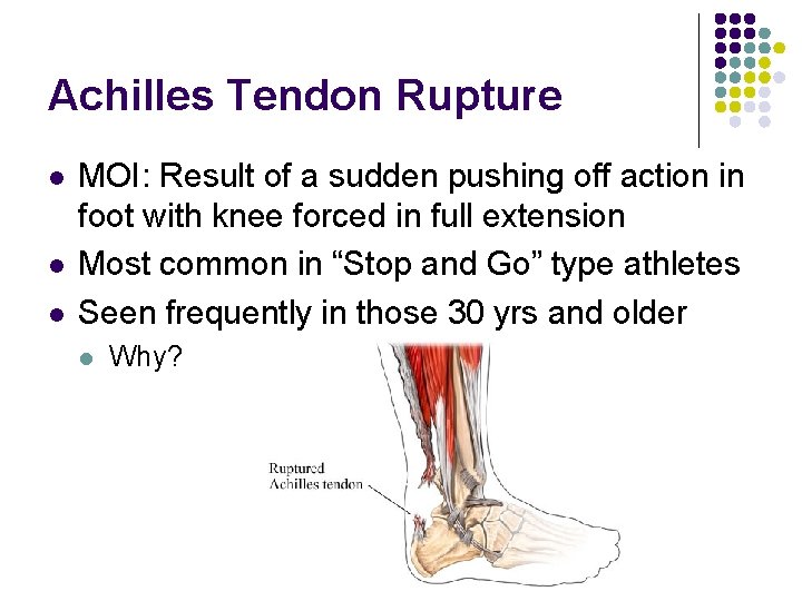 Achilles Tendon Rupture l l l MOI: Result of a sudden pushing off action