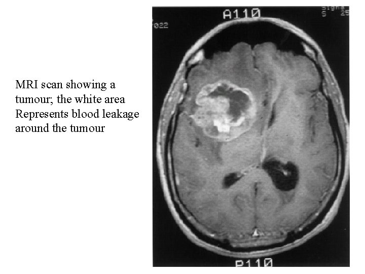 MRI scan showing a tumour; the white area Represents blood leakage around the tumour