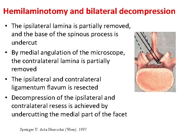 Hemilaminotomy and bilateral decompression • The ipsilateral lamina is partially removed, and the base