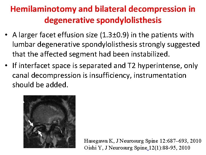 Hemilaminotomy and bilateral decompression in degenerative spondylolisthesis • A larger facet effusion size (1.