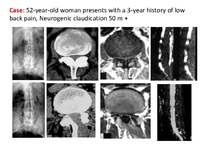 Case: 52 -year-old woman presents with a 3 -year history of low back pain,