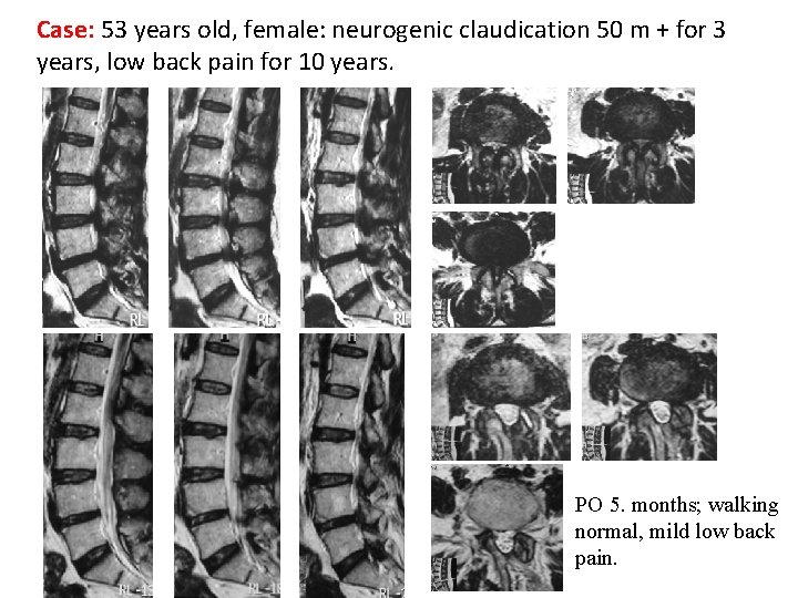 Case: 53 years old, female: neurogenic claudication 50 m + for 3 years, low