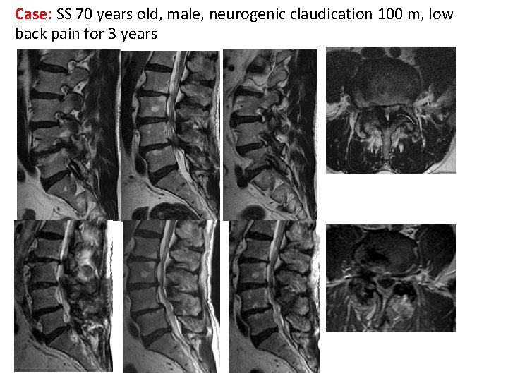 Case: SS 70 years old, male, neurogenic claudication 100 m, low back pain for