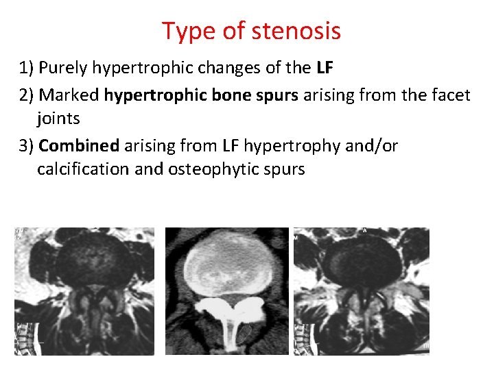 Type of stenosis 1) Purely hypertrophic changes of the LF 2) Marked hypertrophic bone