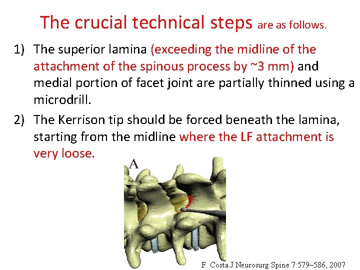 The crucial technical steps are as follows. 1) The superior lamina (exceeding the midline