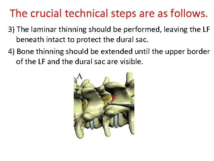 The crucial technical steps are as follows. 3) The laminar thinning should be performed,