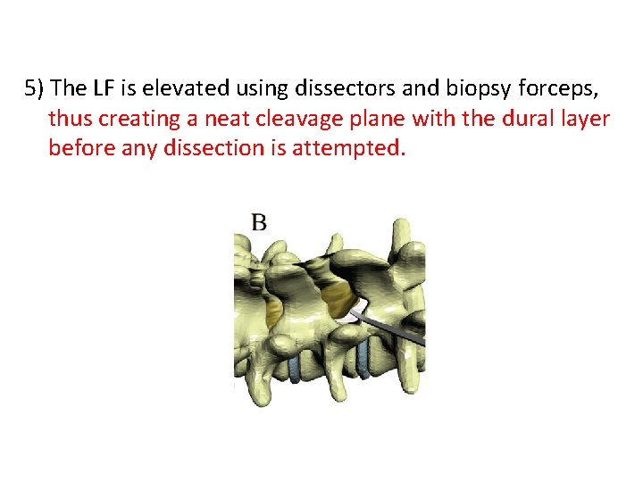 5) The LF is elevated using dissectors and biopsy forceps, thus creating a neat