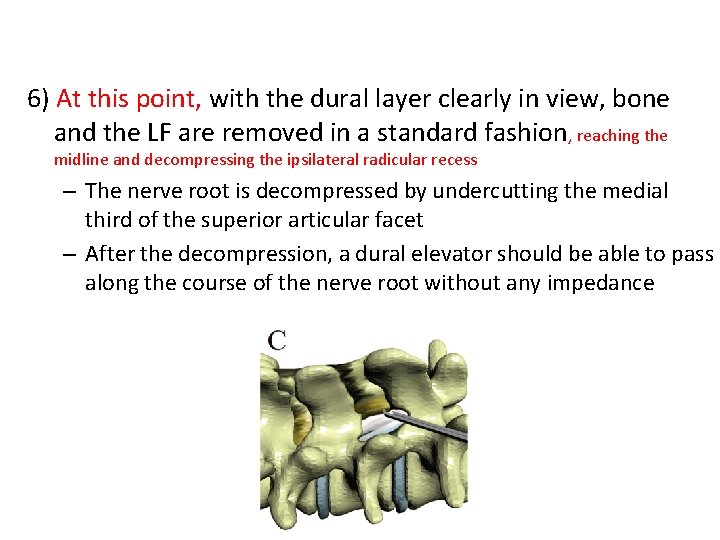 6) At this point, with the dural layer clearly in view, bone and the