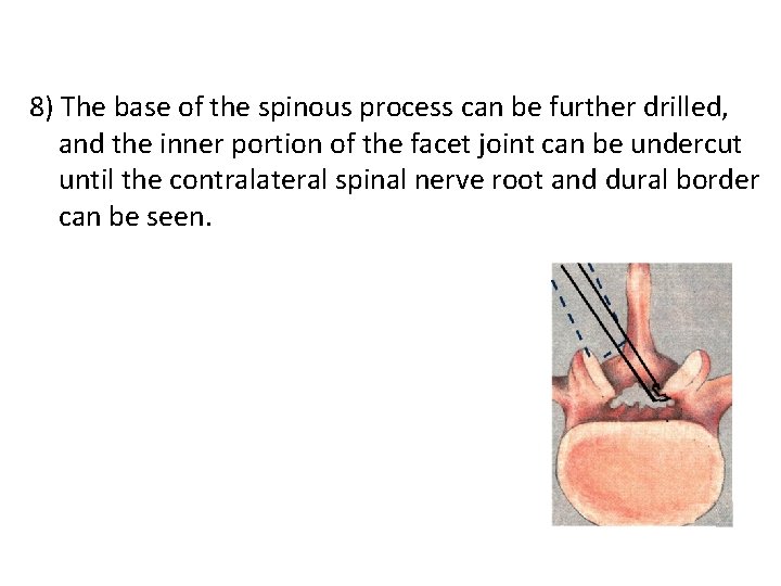 8) The base of the spinous process can be further drilled, and the inner