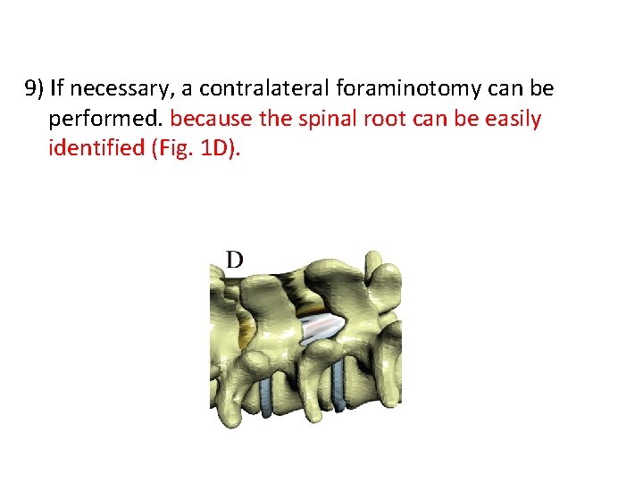 9) If necessary, a contralateral foraminotomy can be performed. because the spinal root can